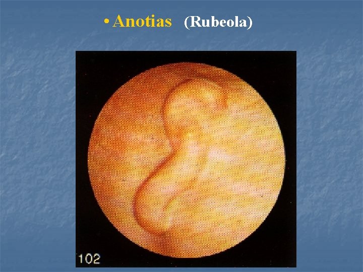  • Anotias (Rubeola) 