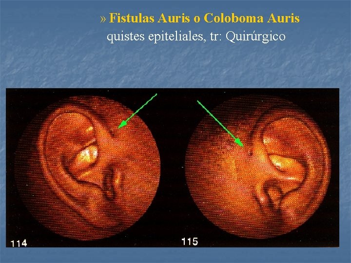 » Fistulas Auris o Coloboma Auris quistes epiteliales, tr: Quirúrgico 