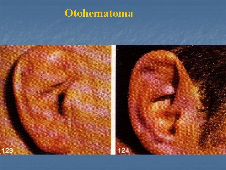 Otohematoma 