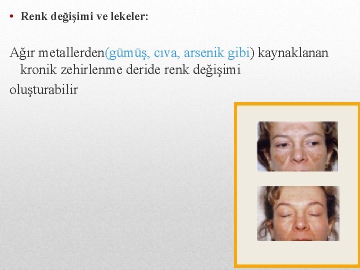  • Renk değişimi ve lekeler: Ağır metallerden(gümüş, cıva, arsenik gibi) kaynaklanan kronik zehirlenme