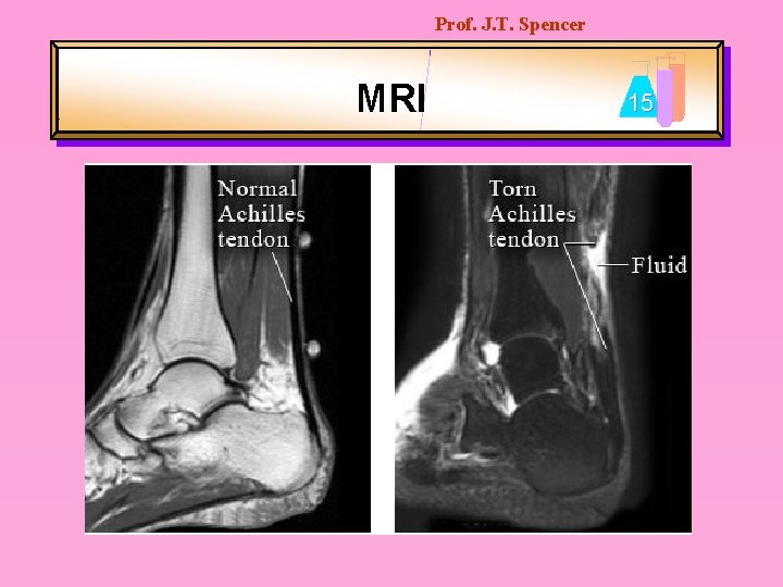 Prof. J. T. Spencer MRI 15 