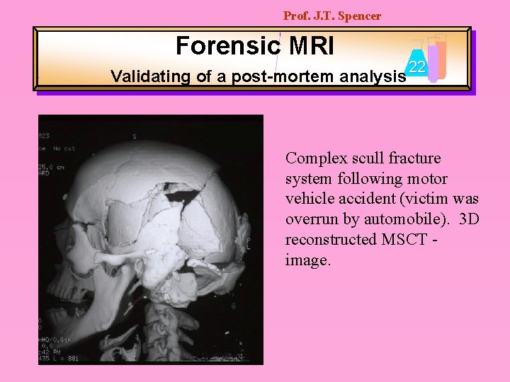Prof. J. T. Spencer Forensic MRI Validating of a post-mortem analysis 22 Complex scull