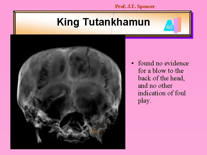 Prof. J. T. Spencer King Tutankhamun 46 • found no evidence for a blow