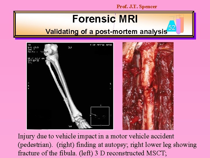 Prof. J. T. Spencer Forensic MRI Validating of a post-mortem analysis 52 Injury due