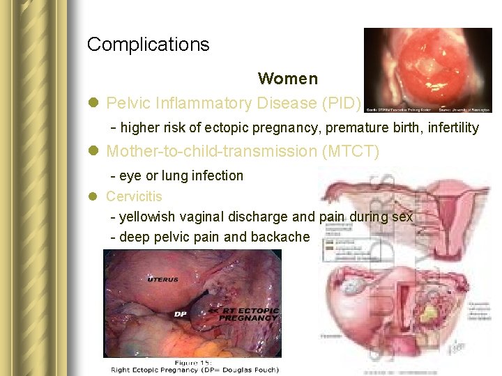 Complications Women l Pelvic Inflammatory Disease (PID) - higher risk of ectopic pregnancy, premature Complications Women l Pelvic Inflammatory Disease (PID) - higher risk of ectopic pregnancy, premature