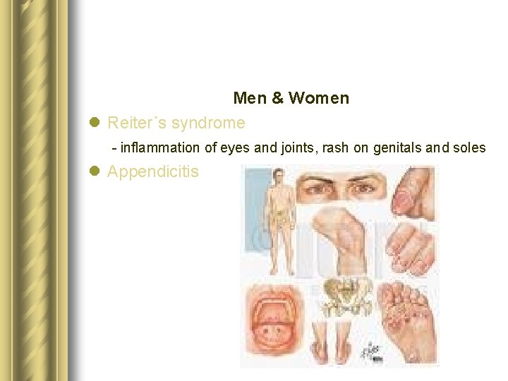 Men & Women l Reiter´s syndrome - inflammation of eyes and joints, rash on Men & Women l Reiter´s syndrome - inflammation of eyes and joints, rash on