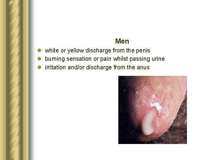 Men l white or yellow discharge from the penis l burning sensation or pain Men l white or yellow discharge from the penis l burning sensation or pain