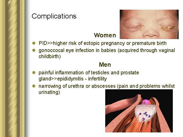Complications Women l PID>>higher risk of ectopic pregnancy or premature birth l gonoccocal eye Complications Women l PID>>higher risk of ectopic pregnancy or premature birth l gonoccocal eye