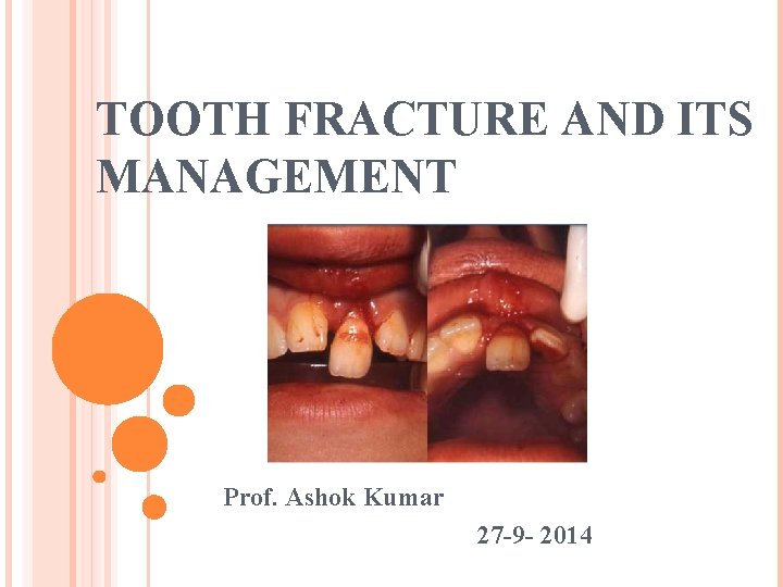 TOOTH FRACTURE AND ITS MANAGEMENT Prof. Ashok Kumar 27 -9 - 2014 