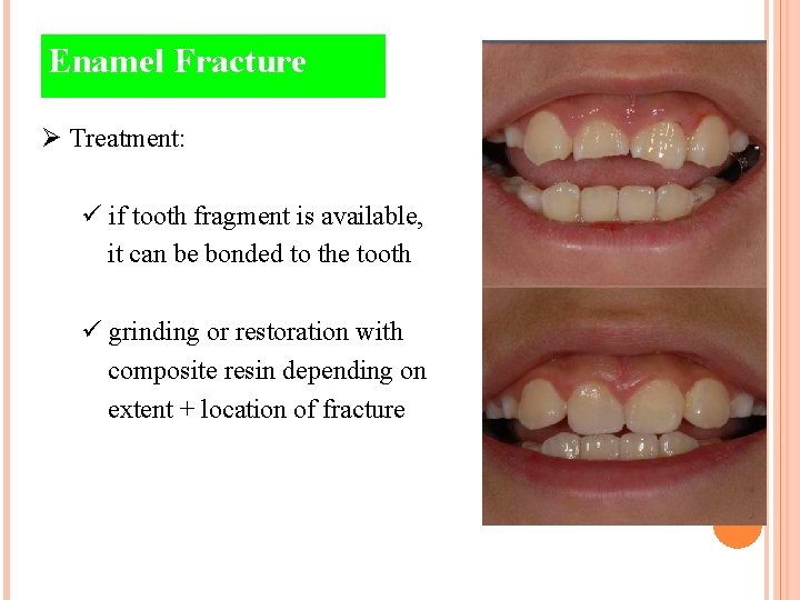 Enamel Fracture Ø Treatment: ü if tooth fragment is available, it can be bonded