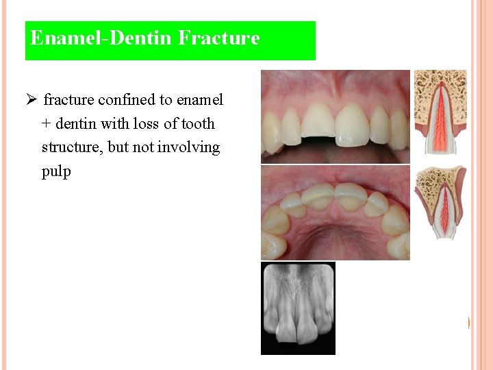 Enamel-Dentin Fracture Ø fracture confined to enamel + dentin with loss of tooth structure,
