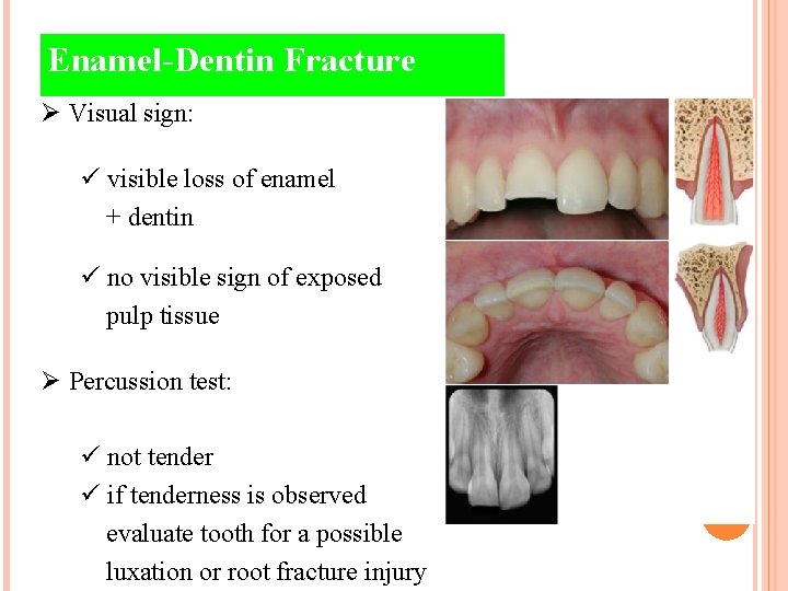 Enamel-Dentin Fracture Ø Visual sign: ü visible loss of enamel + dentin ü no