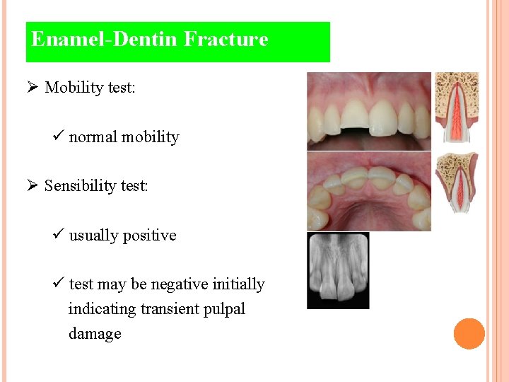 Enamel-Dentin Fracture Ø Mobility test: ü normal mobility Ø Sensibility test: ü usually positive