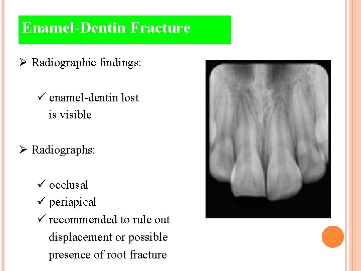 Enamel-Dentin Fracture Ø Radiographic findings: ü enamel-dentin lost is visible Ø Radiographs: ü occlusal