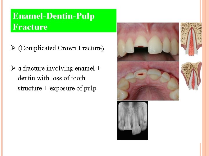 Enamel-Dentin-Pulp Fracture Ø (Complicated Crown Fracture) Ø a fracture involving enamel + dentin with