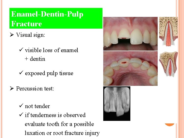 Enamel-Dentin-Pulp Fracture Ø Visual sign: ü visible loss of enamel + dentin ü exposed