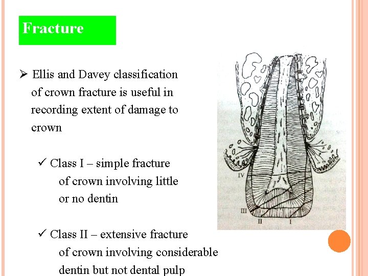 Fracture Ø Ellis and Davey classification of crown fracture is useful in recording extent