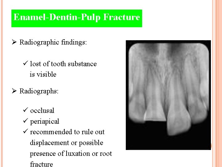 Enamel-Dentin-Pulp Fracture Ø Radiographic findings: ü lost of tooth substance is visible Ø Radiographs: