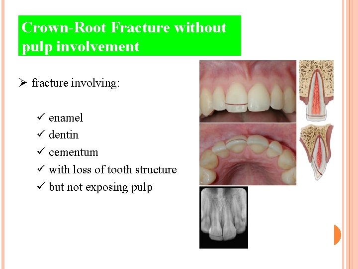 Crown-Root Fracture without pulp involvement Ø fracture involving: ü enamel ü dentin ü cementum