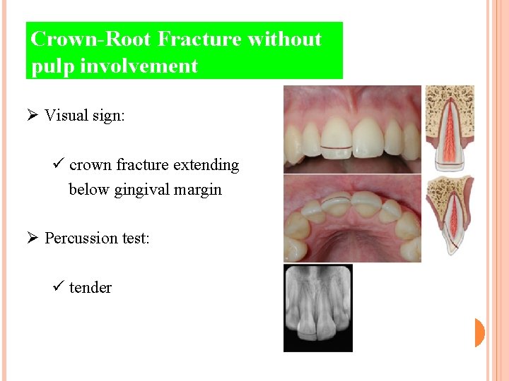 Crown-Root Fracture without pulp involvement Ø Visual sign: ü crown fracture extending below gingival