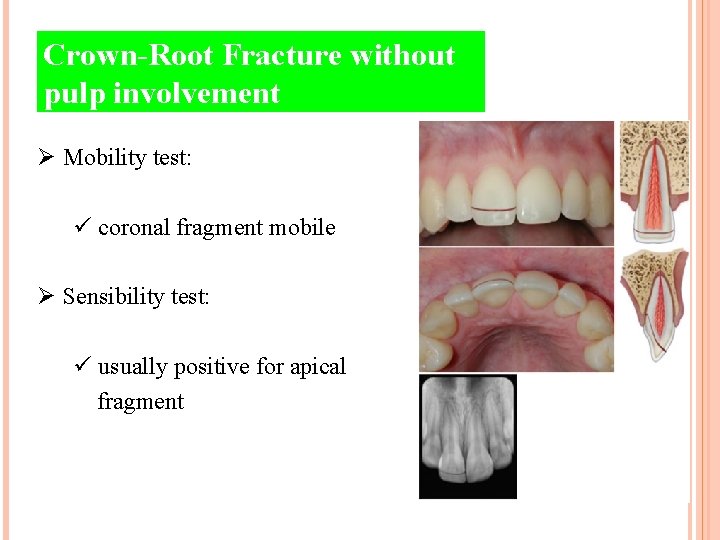 Crown-Root Fracture without pulp involvement Ø Mobility test: ü coronal fragment mobile Ø Sensibility