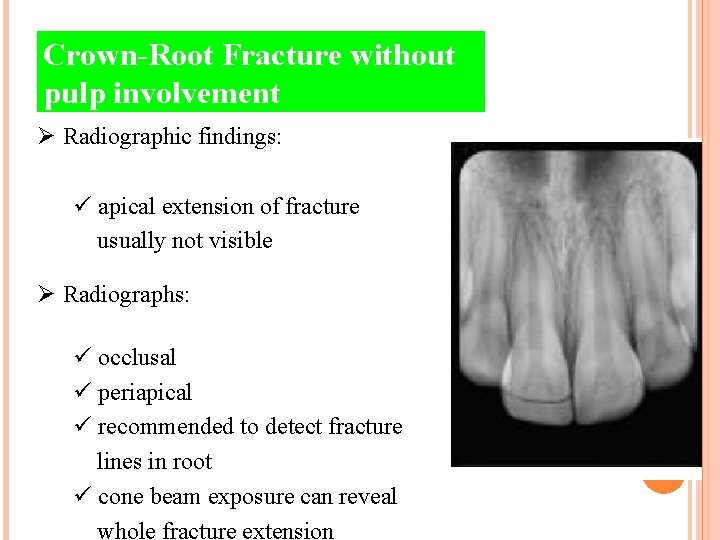 Crown-Root Fracture without pulp involvement Ø Radiographic findings: ü apical extension of fracture usually