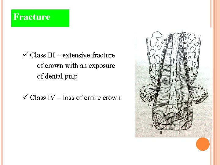 Fracture ü Class III – extensive fracture of crown with an exposure of dental