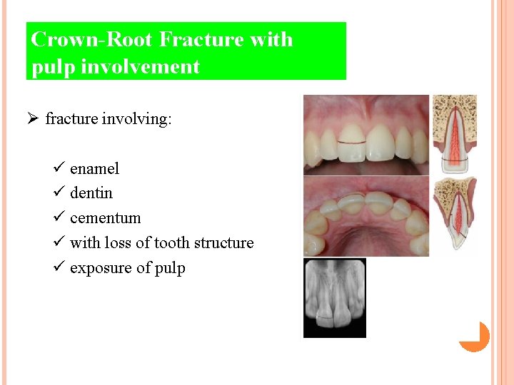 Crown-Root Fracture with pulp involvement Ø fracture involving: ü enamel ü dentin ü cementum