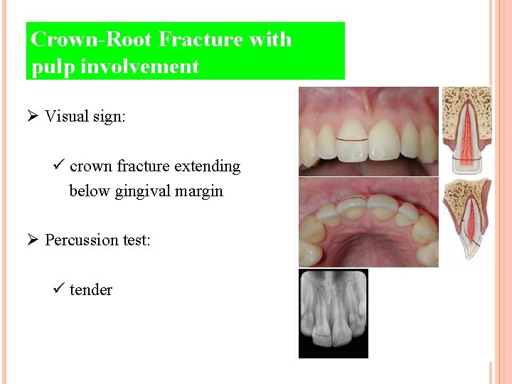 Crown-Root Fracture with pulp involvement Ø Visual sign: ü crown fracture extending below gingival
