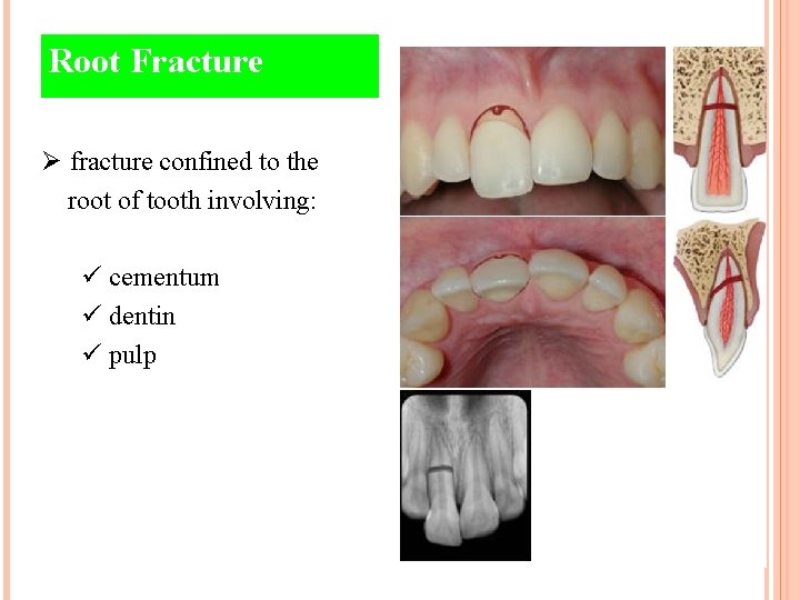 Root Fracture Ø fracture confined to the root of tooth involving: ü cementum ü