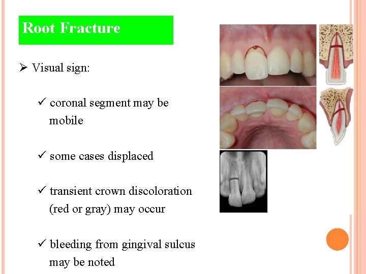 Root Fracture Ø Visual sign: ü coronal segment may be mobile ü some cases