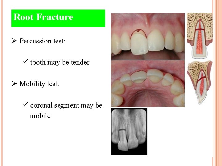 Root Fracture Ø Percussion test: ü tooth may be tender Ø Mobility test: ü