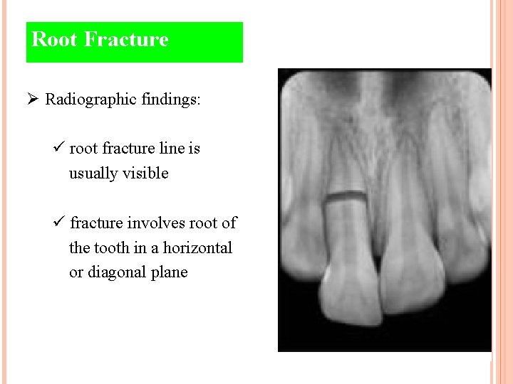 Root Fracture Ø Radiographic findings: ü root fracture line is usually visible ü fracture