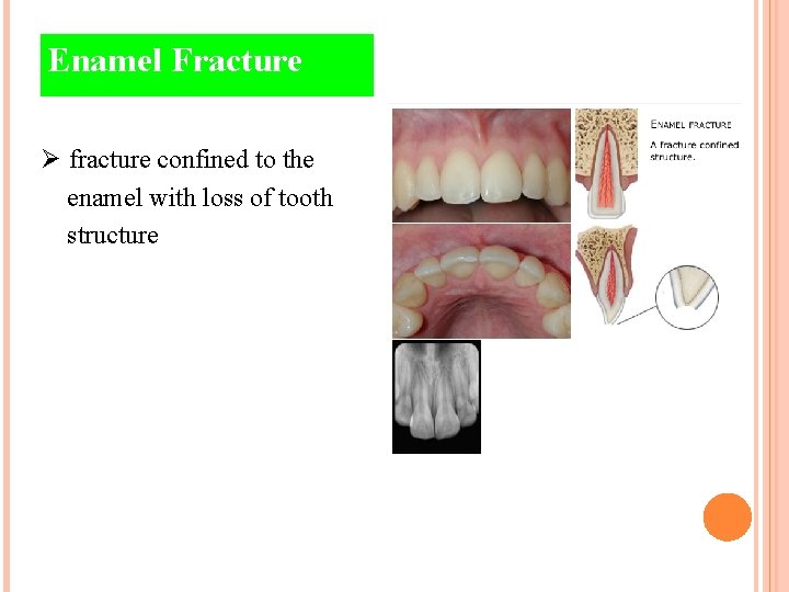 Enamel Fracture Ø fracture confined to the enamel with loss of tooth structure 