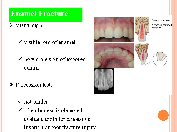 Enamel Fracture Ø Visual sign: ü visible loss of enamel ü no visible sign