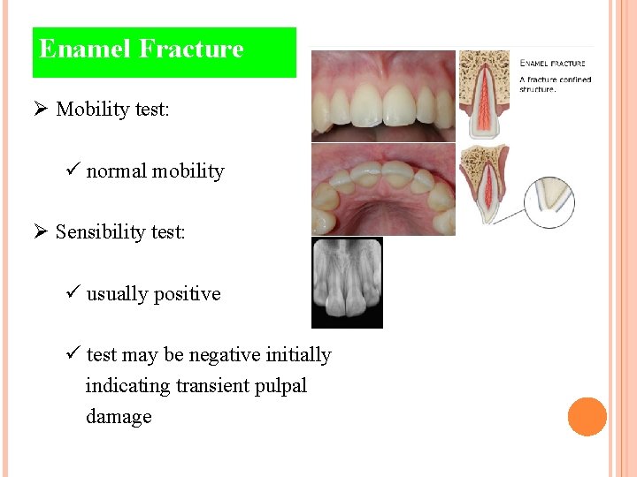 Enamel Fracture Ø Mobility test: ü normal mobility Ø Sensibility test: ü usually positive