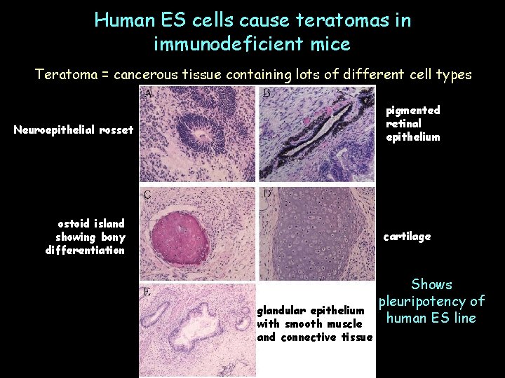 Human ES cells cause teratomas in immunodeficient mice Teratoma = cancerous tissue containing lots