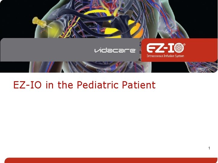EZ-IO in the Pediatric Patient 1 
