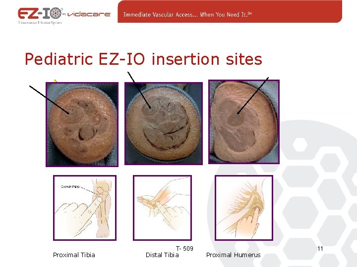 Pediatric EZ-IO insertion sites Proximal Tibia T- 509 Distal Tibia Proximal Humerus 11 