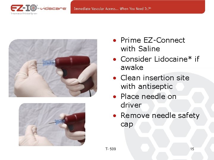  • Prime EZ-Connect with Saline • Consider Lidocaine* if awake • Clean insertion