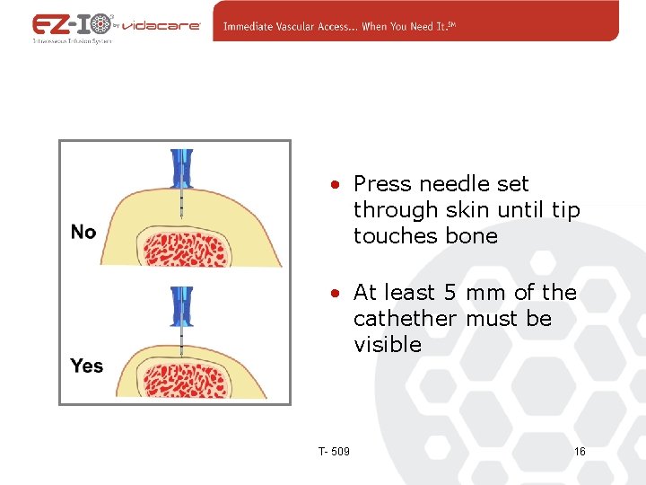  • Press needle set through skin until tip touches bone • At least