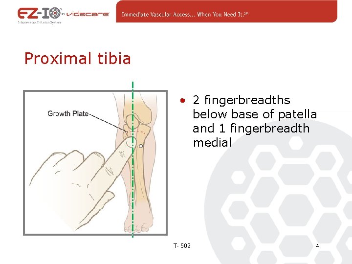 Proximal tibia • 2 fingerbreadths below base of patella and 1 fingerbreadth medial T-