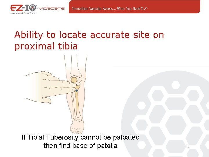 Ability to locate accurate site on proximal tibia If Tibial Tuberosity cannot be palpated