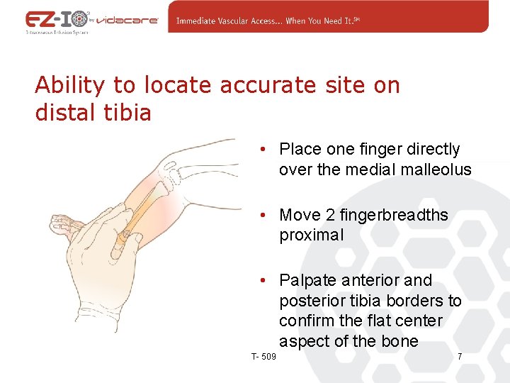 Ability to locate accurate site on distal tibia • Place one finger directly over