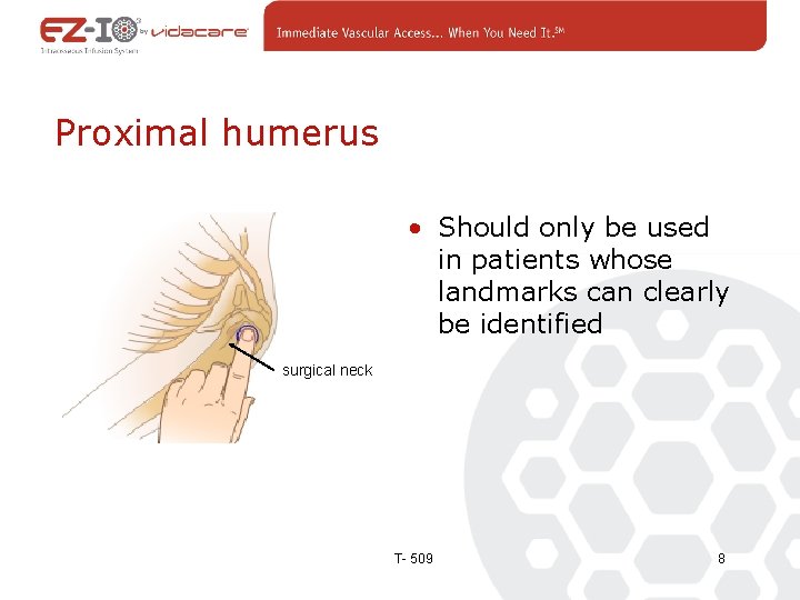 Proximal humerus • Should only be used in patients whose landmarks can clearly be