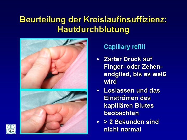 Beurteilung der Kreislaufinsuffizienz: Hautdurchblutung Capillary refill • Zarter Druck auf Finger- oder Zehenendglied, bis Beurteilung der Kreislaufinsuffizienz: Hautdurchblutung Capillary refill • Zarter Druck auf Finger- oder Zehenendglied, bis