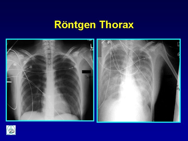 Röntgen Thorax 