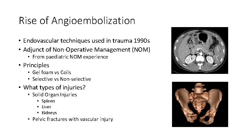 Rise of Angioembolization • Endovascular techniques used in trauma 1990 s • Adjunct of