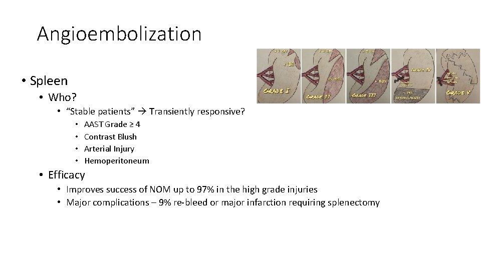 Angioembolization • Spleen • Who? • “Stable patients” Transiently responsive? • • AAST Grade