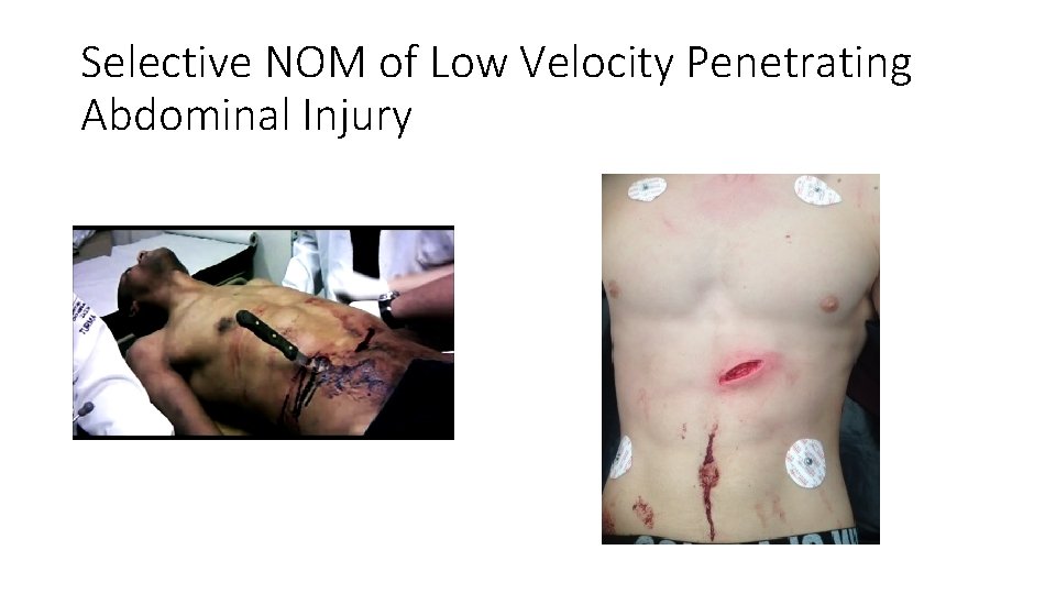 Selective NOM of Low Velocity Penetrating Abdominal Injury 